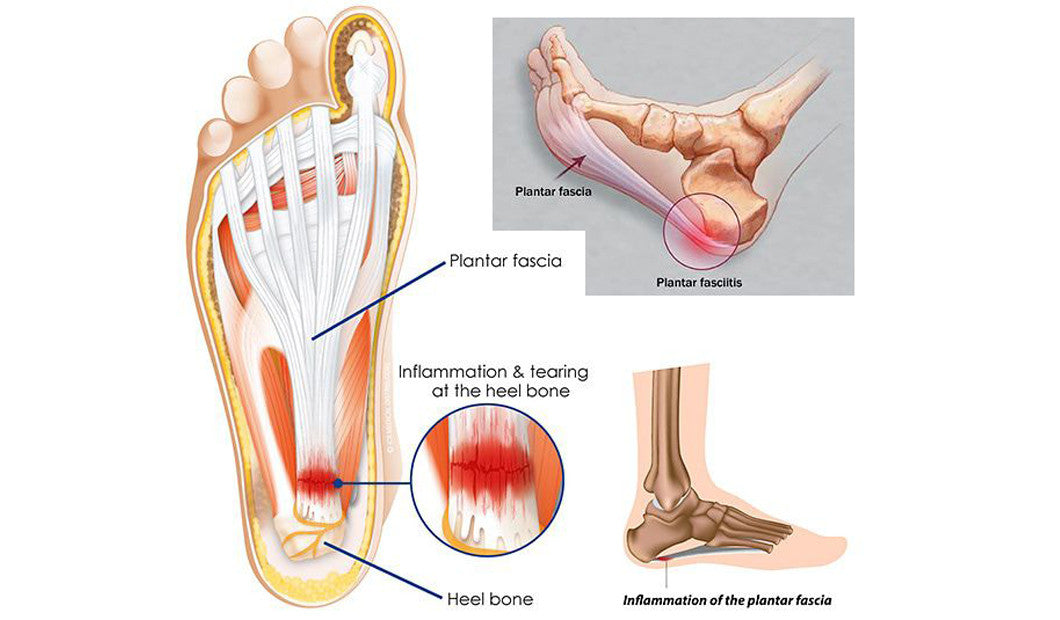 10 Ways To Tame Plantar Fasciitis