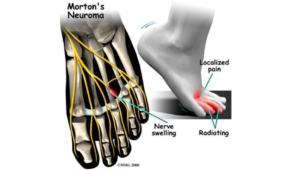 Pain in the Front of the Foot May Be a Neuroma